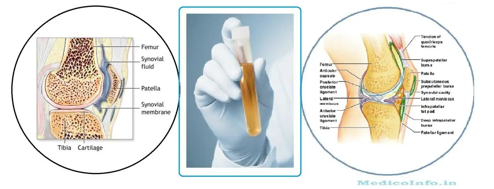 مایع مفصل شانه مایع مفصل شانه