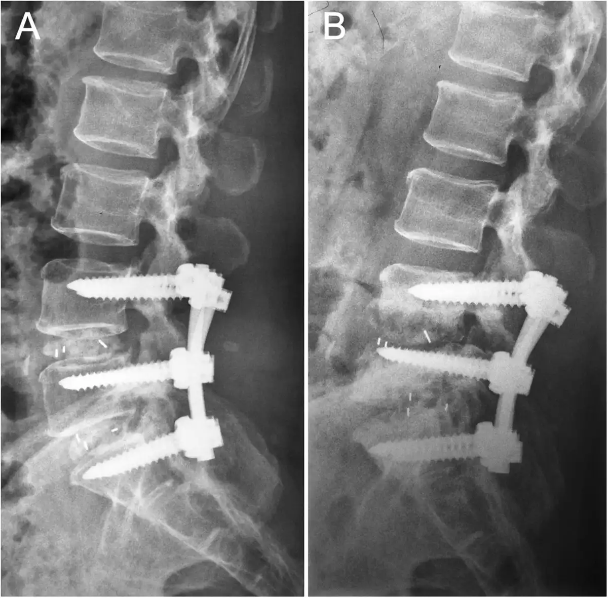 عمل انحراف ستون فقرات عمل انحراف ستون فقرات
