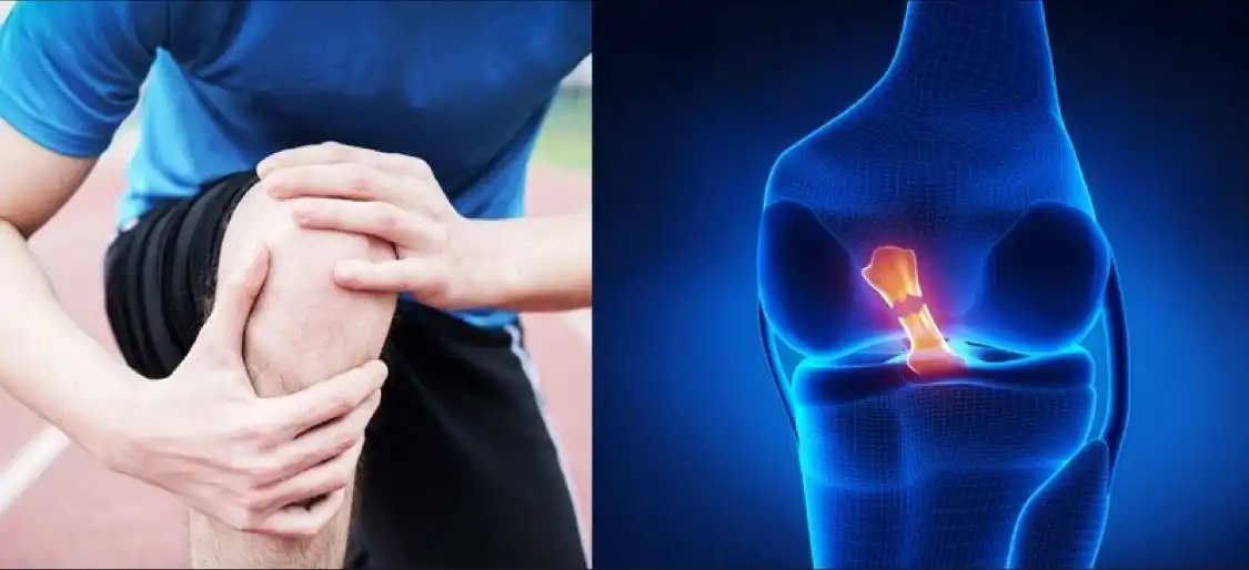 طب سنتی برای درمان پارگی رباجراحی ساییدگی مفصل زانوط صلیبی
