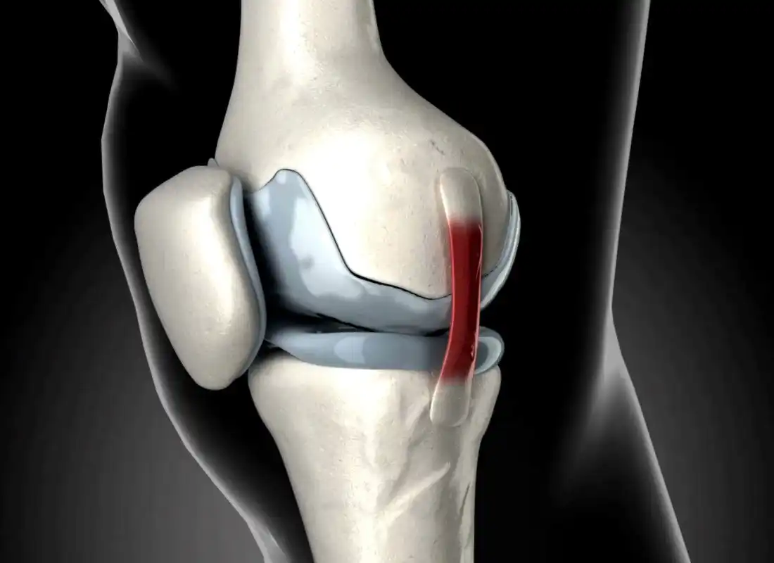 درمان پارگی رباط صلیبی