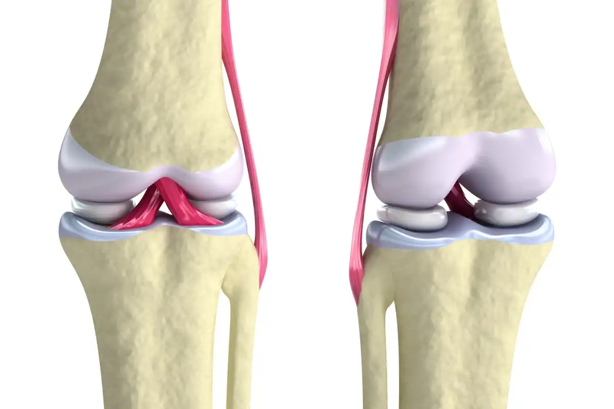 غضروف مصنوعی زانو غضروف مصنوعی زانو