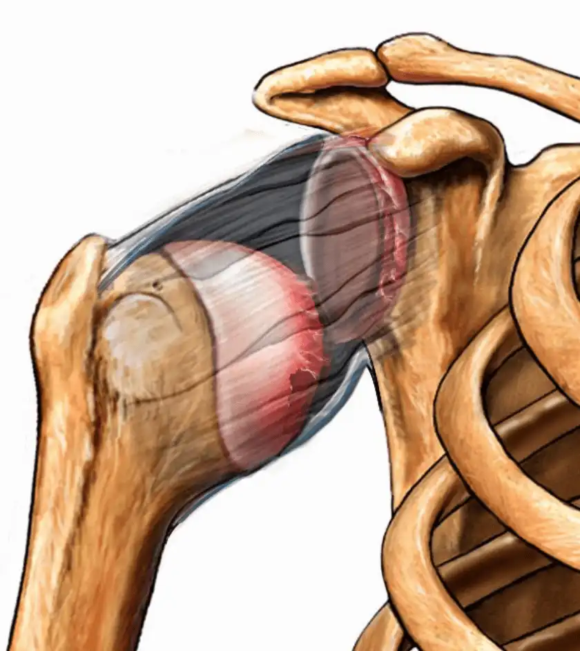 دررفتگی مفصل شانه