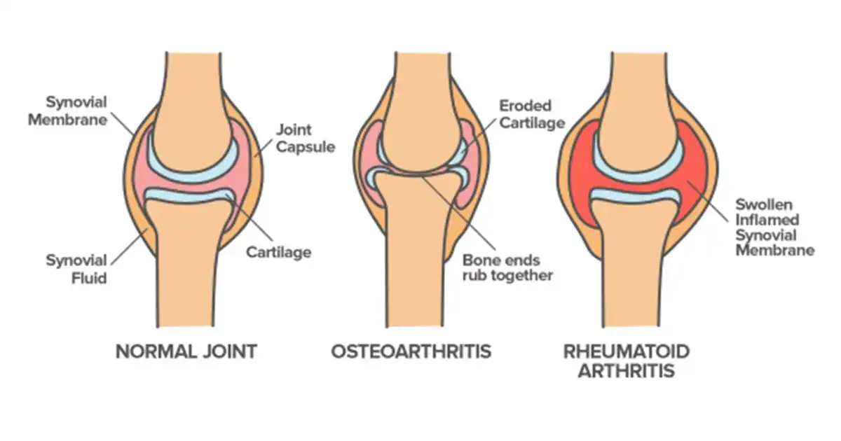 آرتریت روماتوئید مفصل شانه آرتریت روماتوئید مفصل شانه