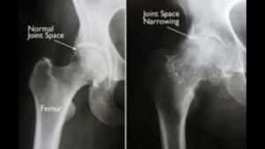 آرتروز مفصل لگن