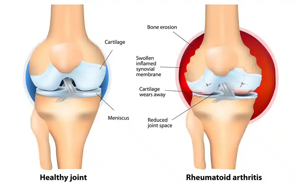عوارض جراحی تعویض مفصل زانو