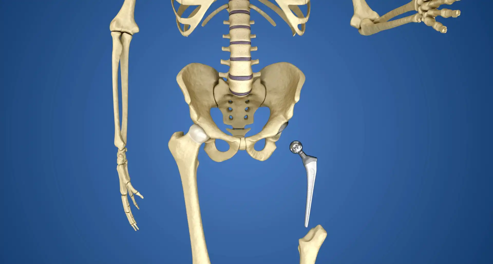 صدا دادن مفصل لگن صدا دادن مفصل لگن