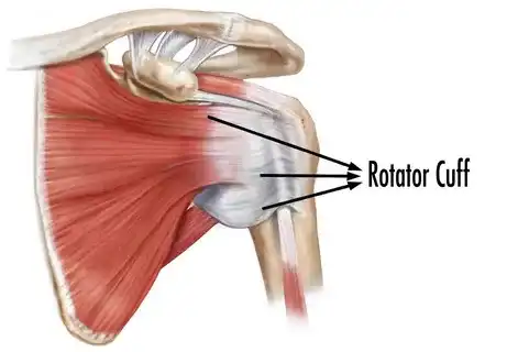 کشیدگی تاندون شانه
