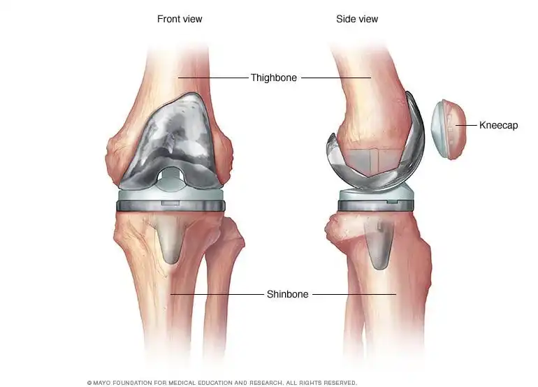 غضروف مصنوعی زانو غضروف مصنوعی زانو