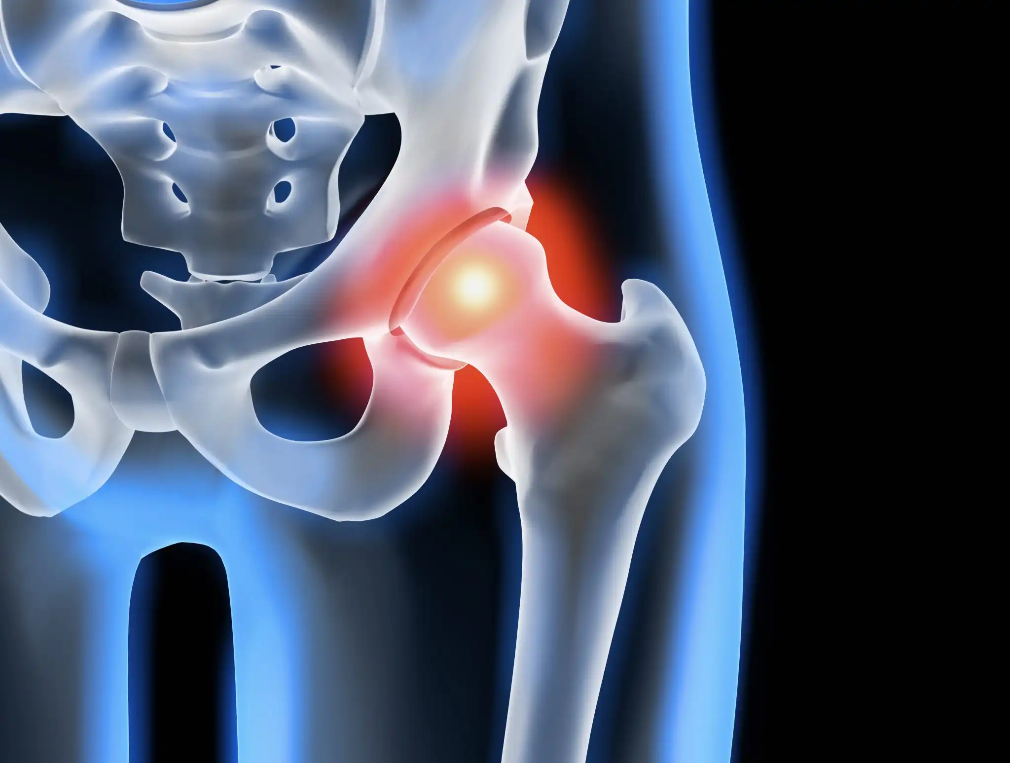 آرتروز مفصل لگن چیست؟ آرتروز مفصل لگن