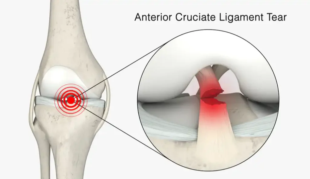 درمان خونریزی مفصل زانو پارگی رباط صلیبی خلفی قدامی