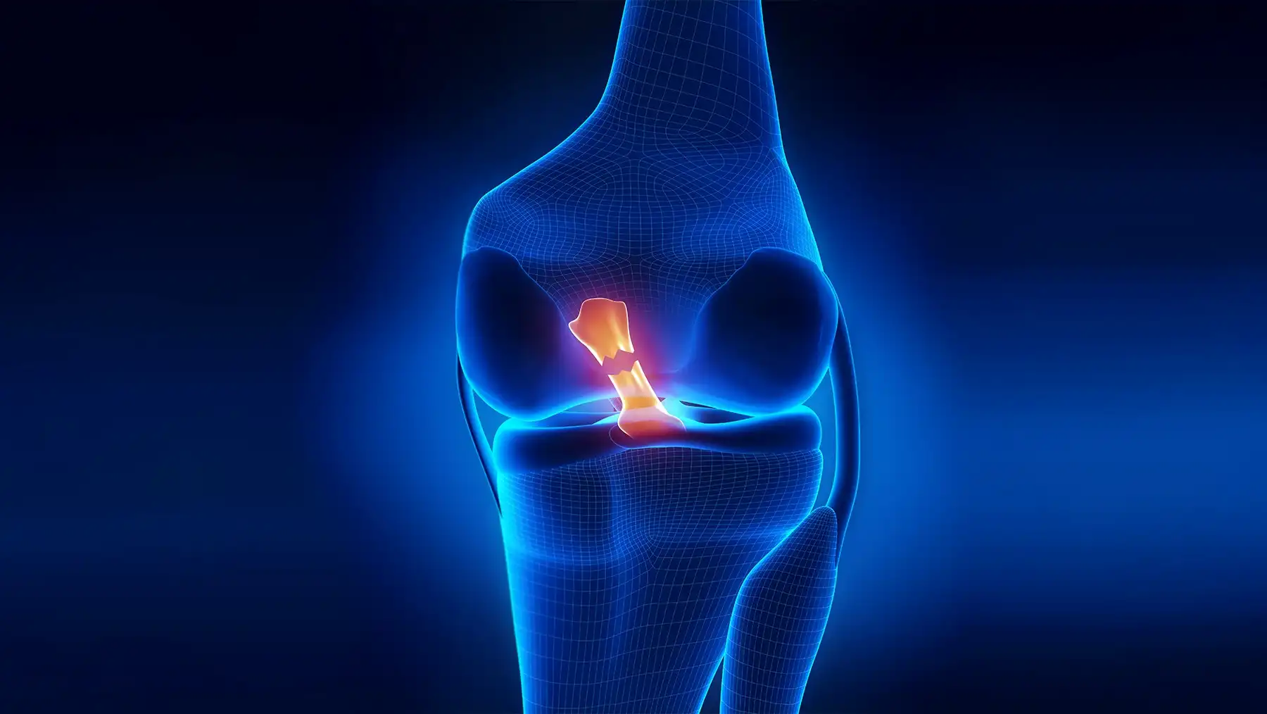 علائم پارگی رباط صلیبی چیست؟