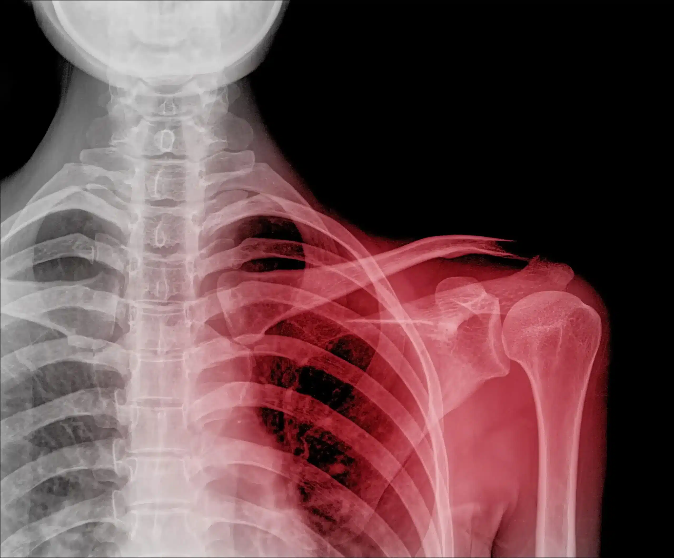 دررفتگی مفصل شانه دررفتگی مفصل شانه