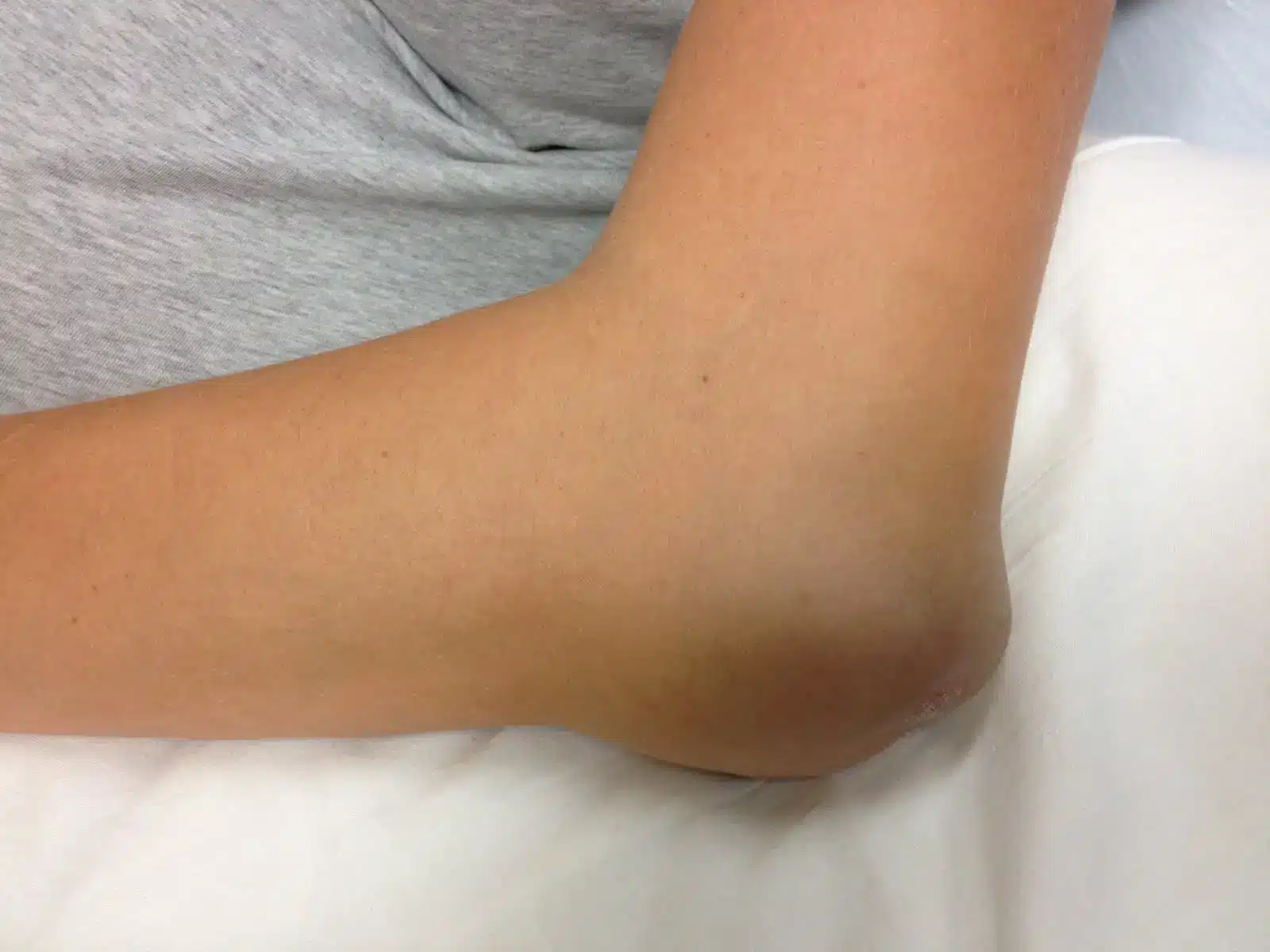 بورسیت اولکرانون چیست بوریست اولکرانون