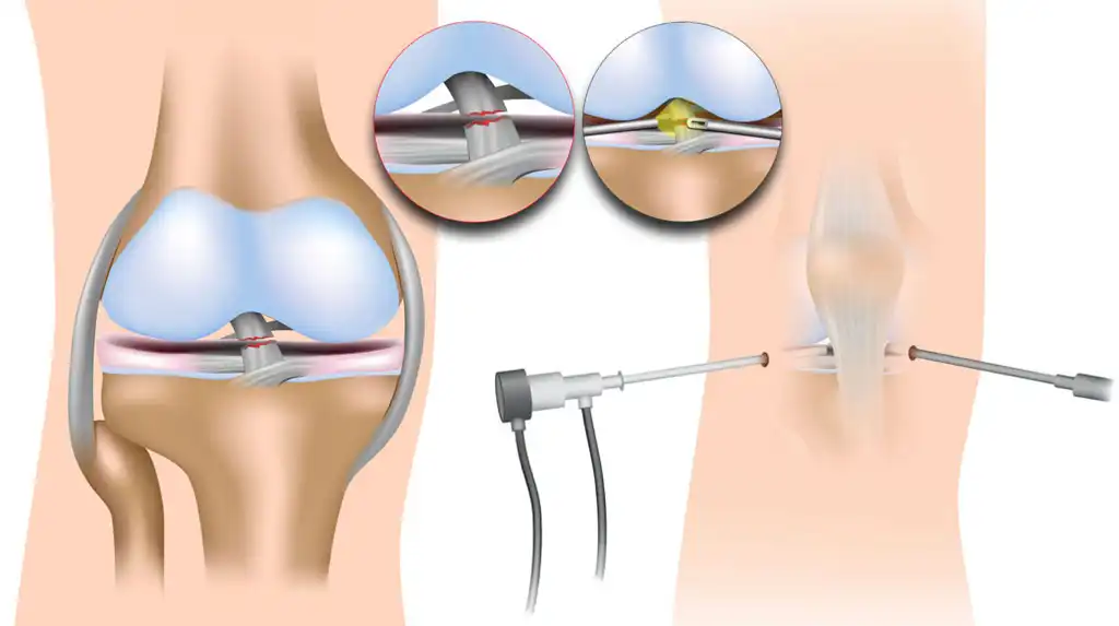 تزریق ژل داخل مفصل زانو