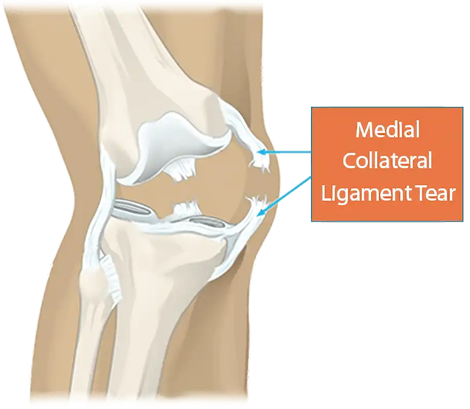 درمان پارگی رباط صلیبی درمان پارگی رباط صلیبی