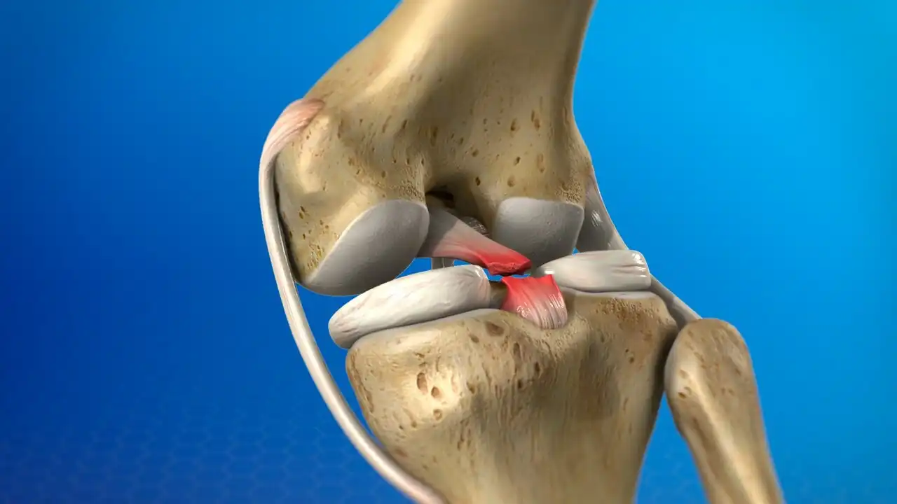 طب سنتی برای درمان پارگی رباط صلیبی