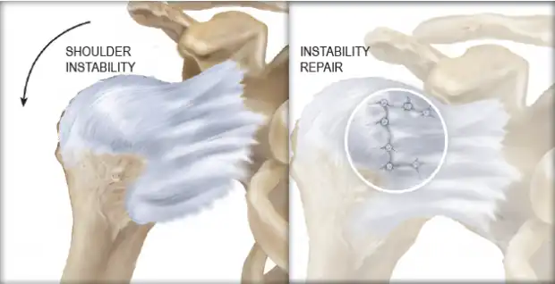 بی ثباتی مفصل شانه بی ثباتی مفصل شانه