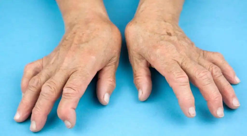 آرتروز و روماتیسم مفصلی آرتروز روماتیسم مفصلی