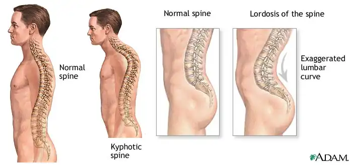 بیماری های ستون فقرات بیماری های ستون فقرات