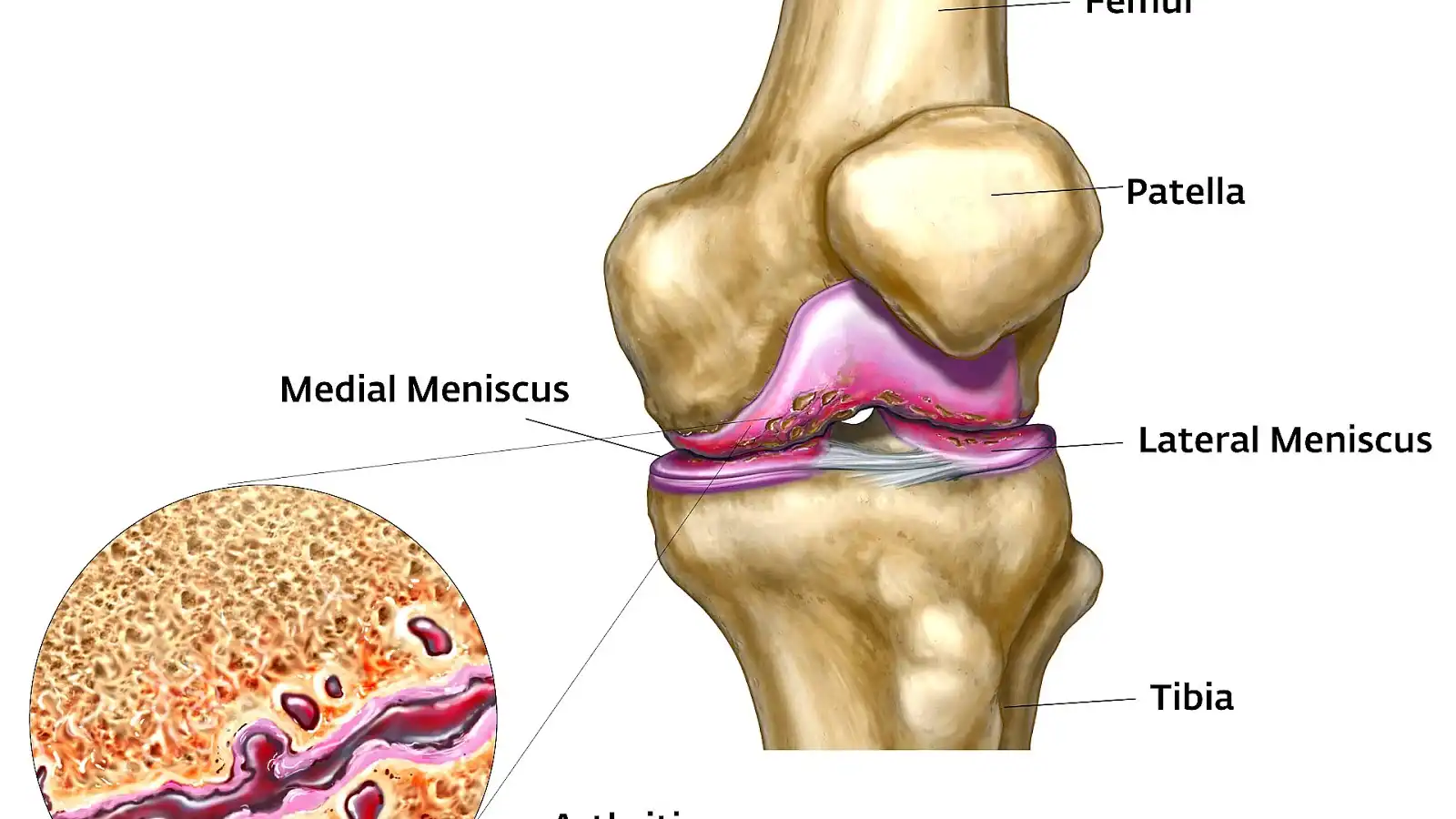 تزریق ژل داخل مفصل زانو تزریق ژل داخل مفصل زانو