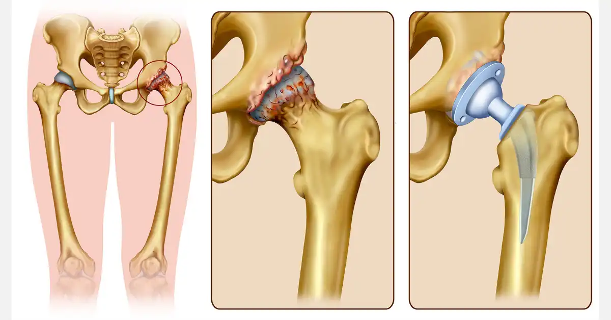 فیلم تعویض مفصل ران لگن