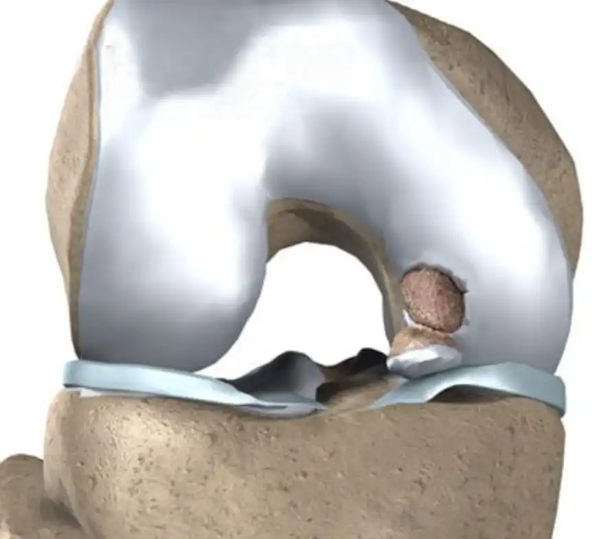 استئوکندریت چیست استئوکندریت