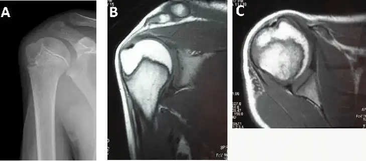 دررفتگی مفصل شانه دررفتگی مفصل شانه