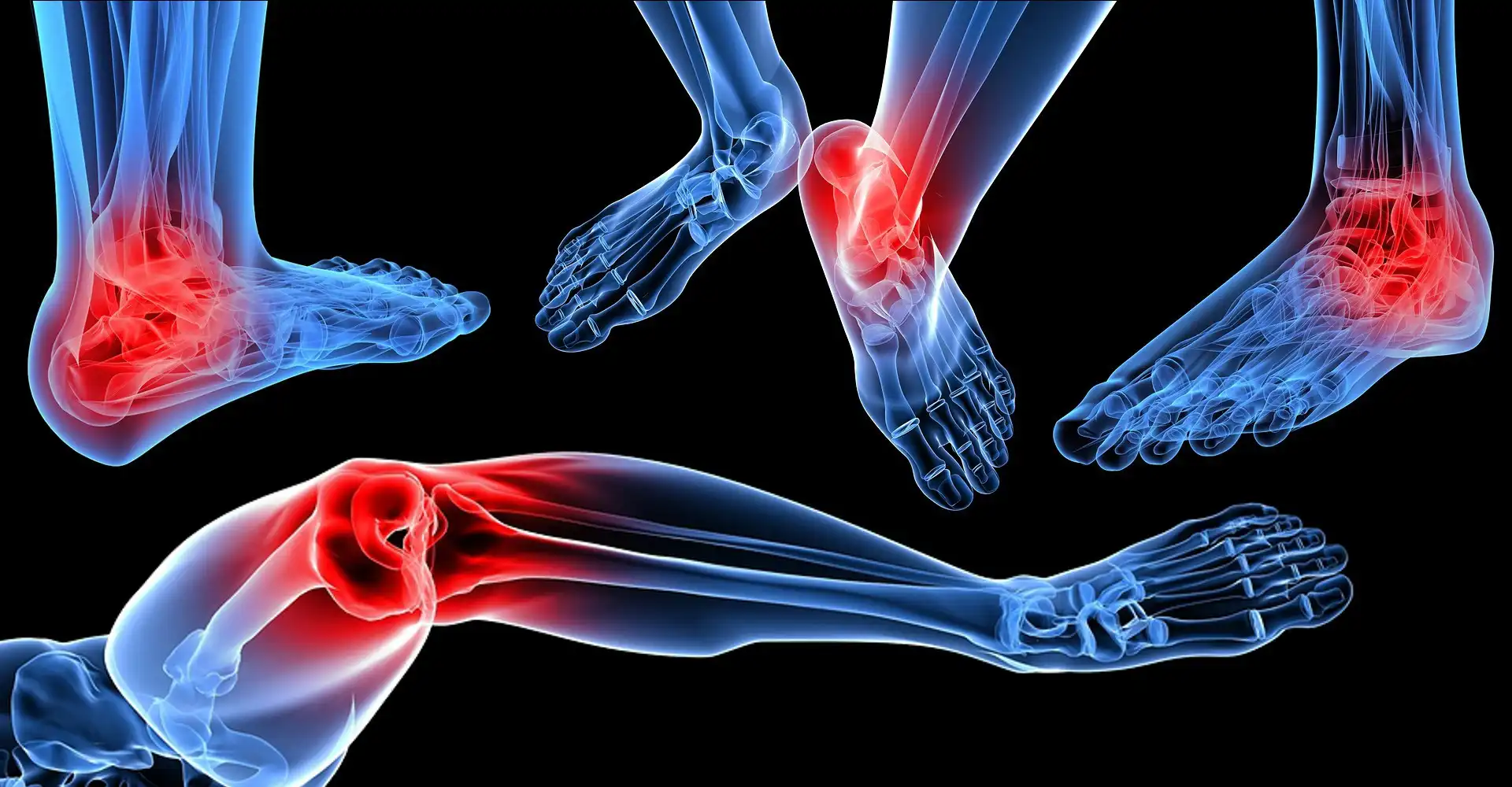 آرتریت پا چیست Arthritis of the foot