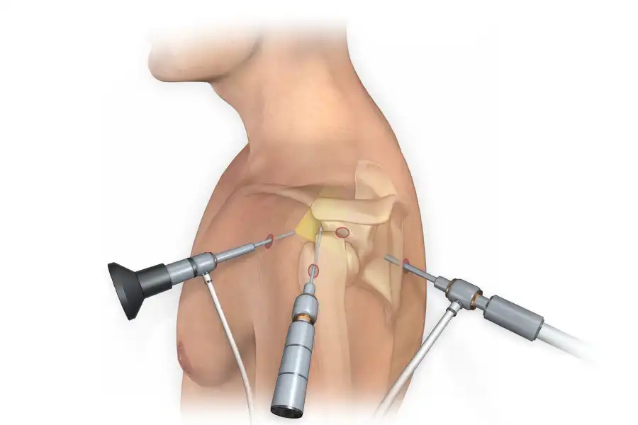 تزریق کورتون به مفصل شانه تزریق کورتون به مفصل شانه