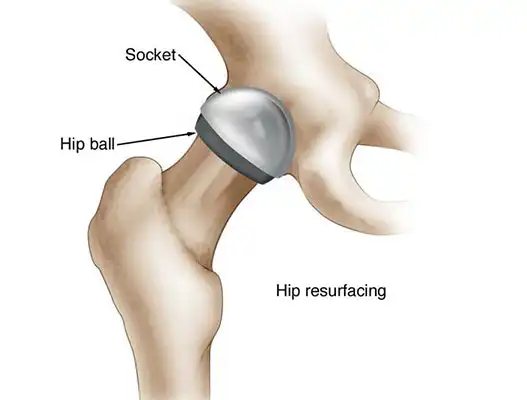 هزینه عمل جراحی تعویض مفصل لگن | راهنمای طلایی برای تصمیمگیری آگاهانه بیماران عزیز هزینه تعویض مفصل لگن