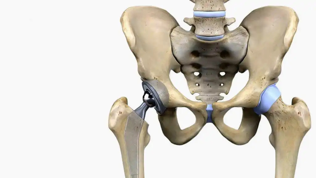 مدت استراحت بعد از عمل تعویض مفصل لگن