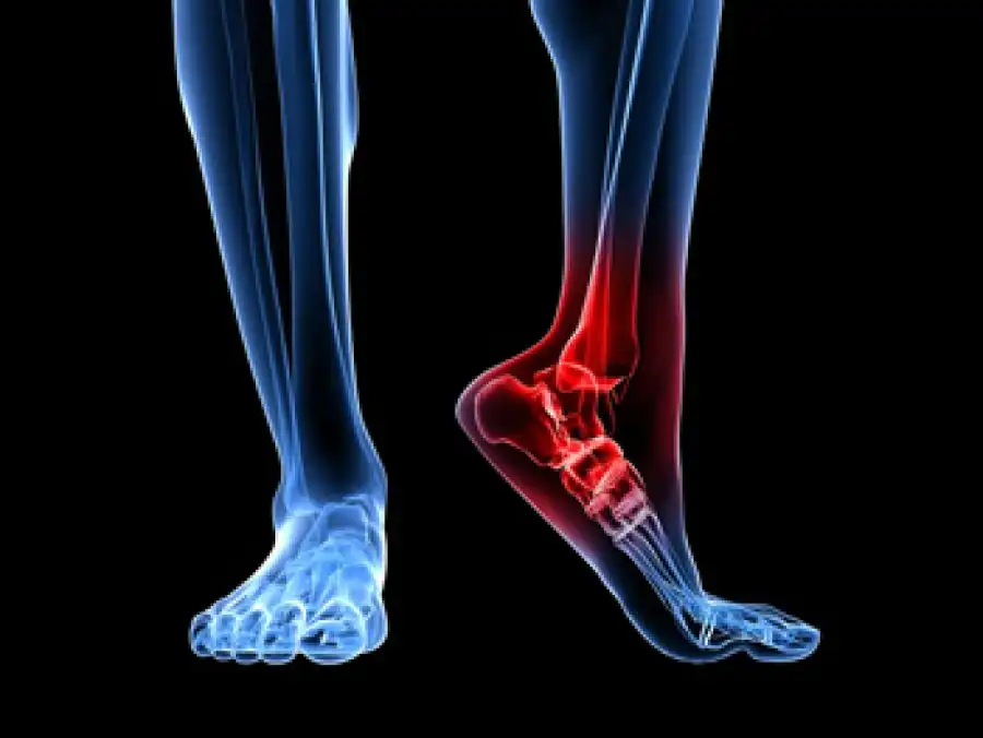 آرتریت پا چیست Arthritis of the foot