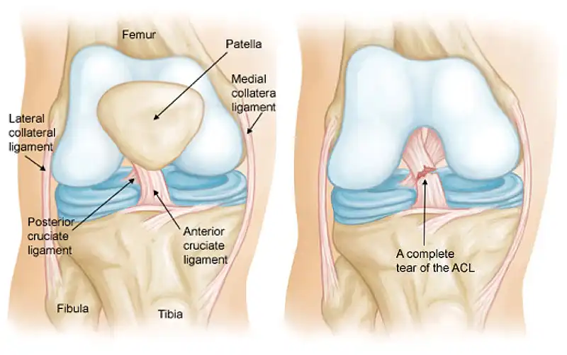 درمان روماتیسم مفصل زانو