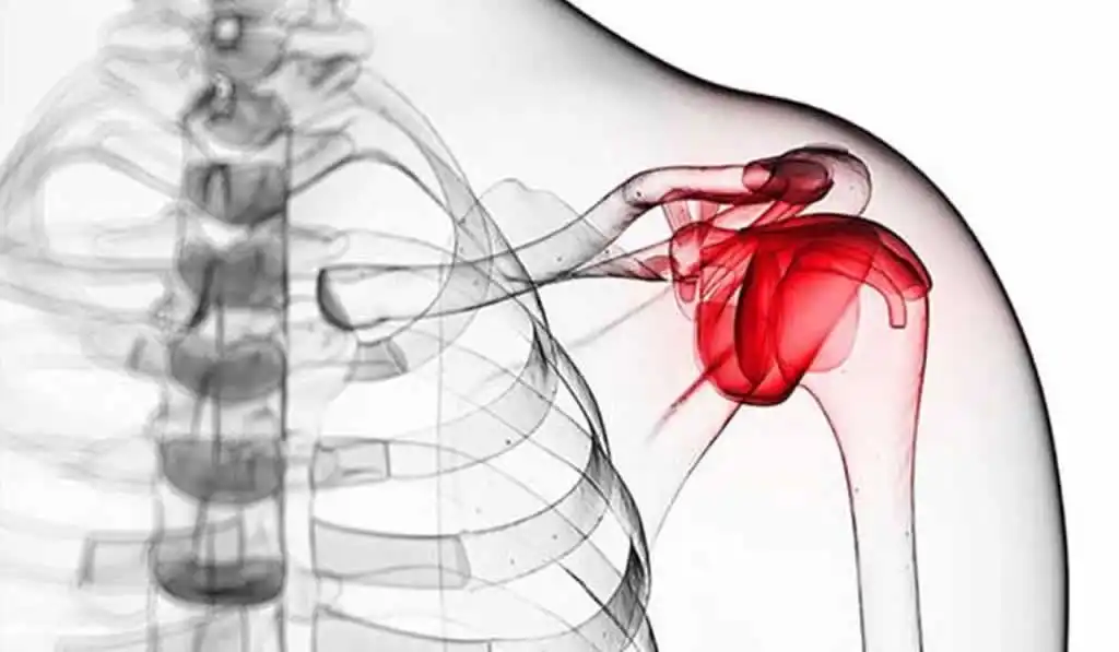 تزریق مفصل شانه تزریق مفصل شانه