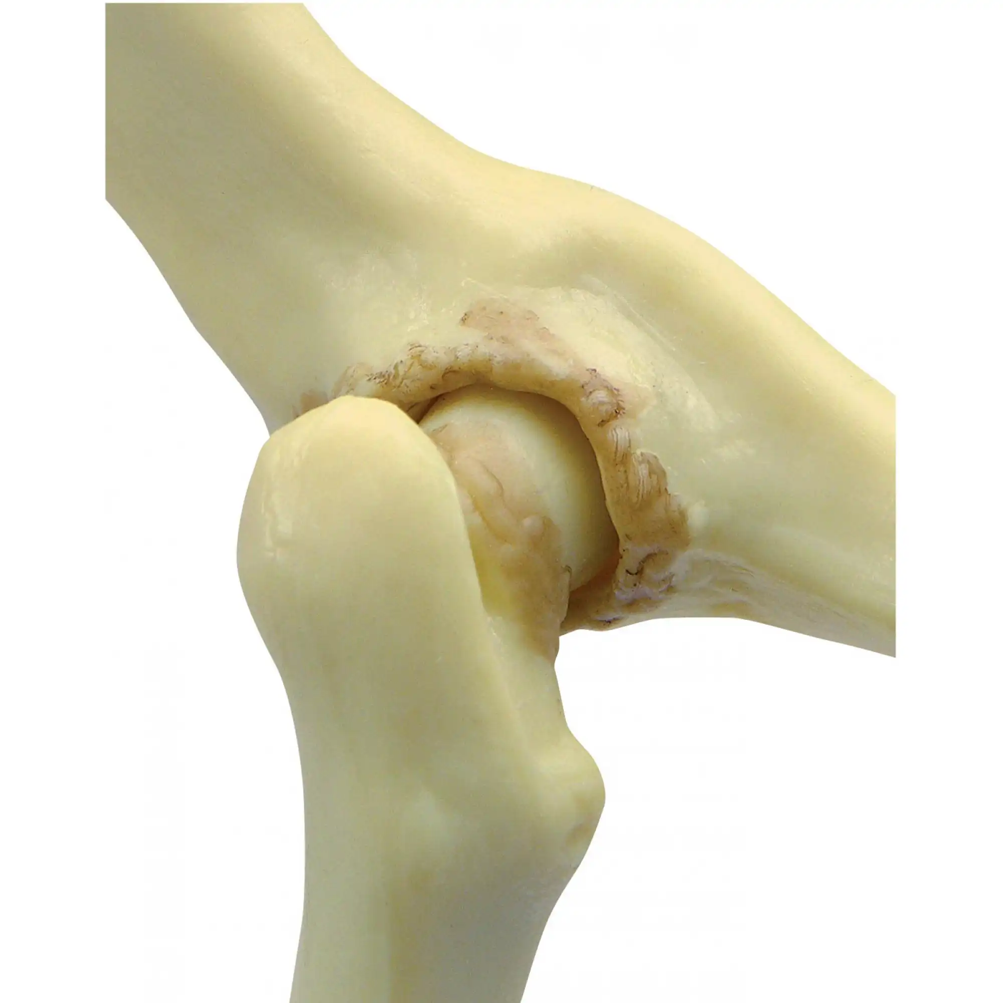 استئوفیت و خار استخوانی چیست استئوفیت