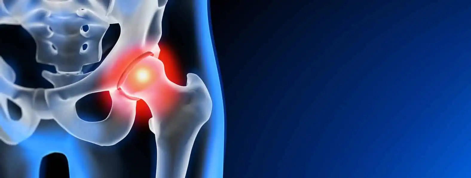درد بعد از عمل تعویض مفصل لگن