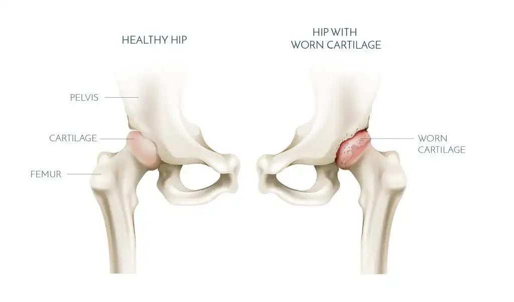 آرتروز مفصل لگن چیست؟