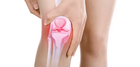 درمان آرتریت مفصل زانو