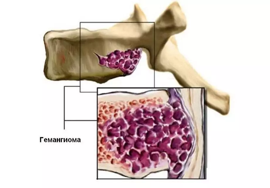 همانژیوم ستون فقرات چیست؟ همانژیوم ستون فقرات چیست