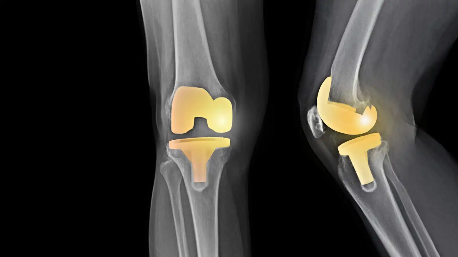درمان غضروف مفصل زانو Cartilage treatment of the knee joint