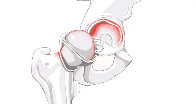 ساییدگی مفصل لگن ساییدگی مفصل لگن