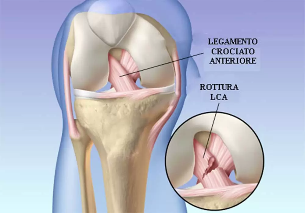 طب سنتی برای درمان پارگی رباط صلیبی