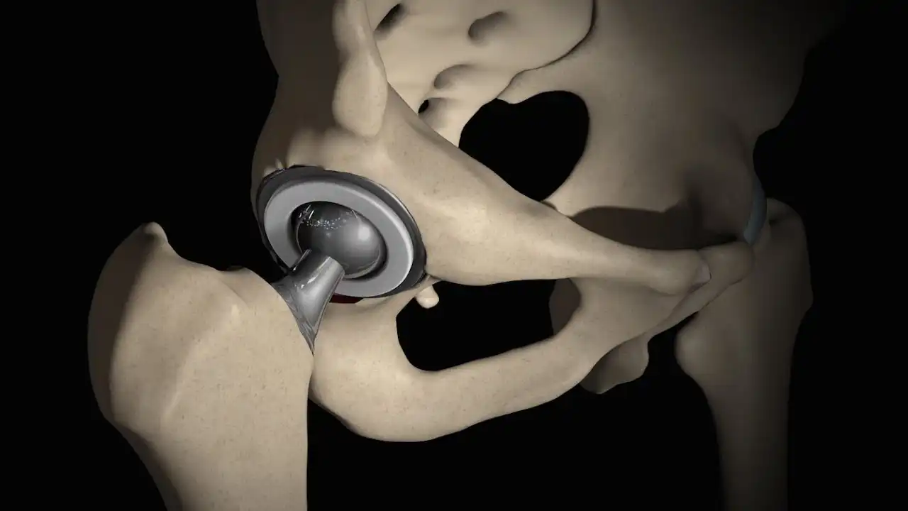 مراقبتهای بعد از عمل تعویض مفصل لگن مراقبتهای بعد از عمل تعویض مفصل لگن