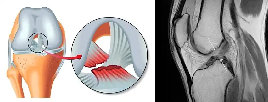 درمان پارگی رباط صلیبی درمان پارگی رباط صلیبی