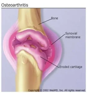 درمان آرتروز مفصلی درمان آرتروز مفصلی