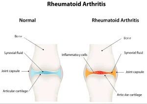 آرتریت روماتوئید مفصل شانه آرتریت روماتوئید مفصل شانه