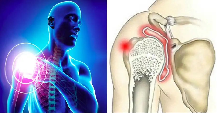 ناپایداری مفصل شانه ناپایداری مفصل شانه