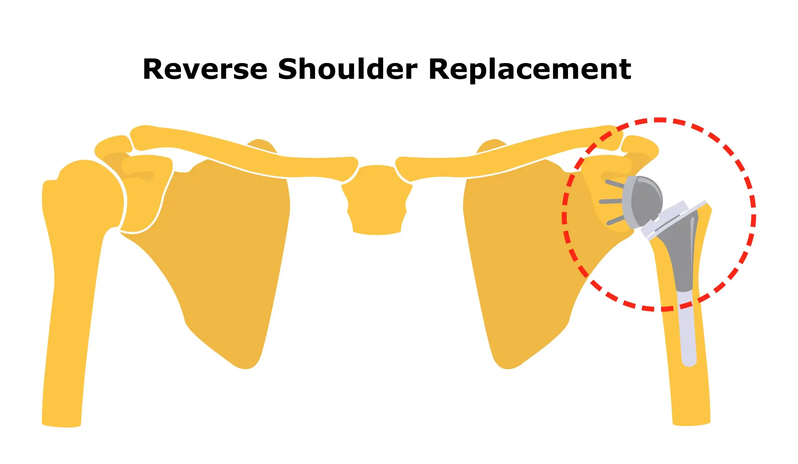 استئوآرتریت مفصل شانه استئوآرتریت مفصل شانه