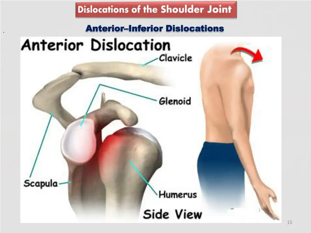 دررفتگی مفصل شانه