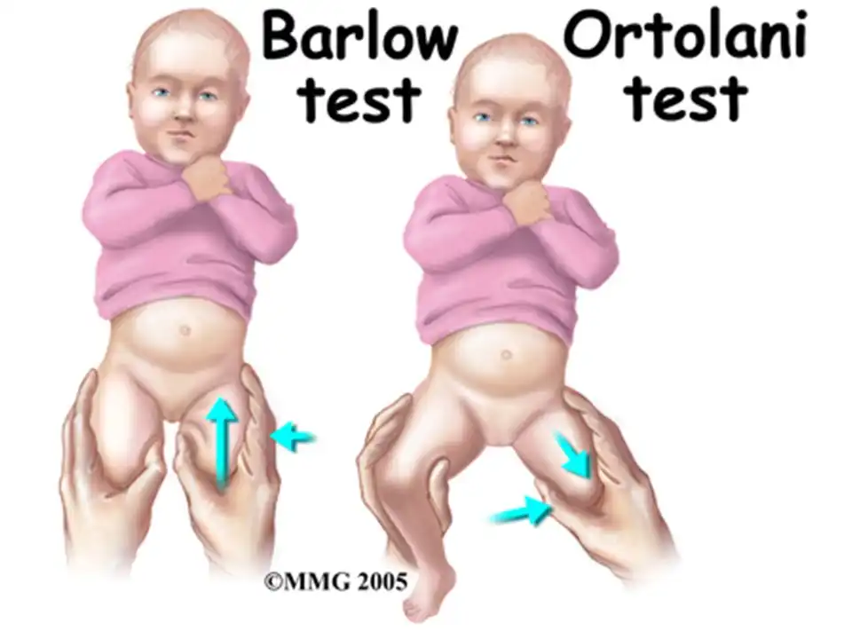 صدا دادن مفصل لگن نوزاد